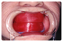 かみ合わせの記録 (咬合採得 こうごうさいとく)