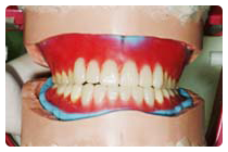 見た目やかみ合わせの確認 (試適 してき)